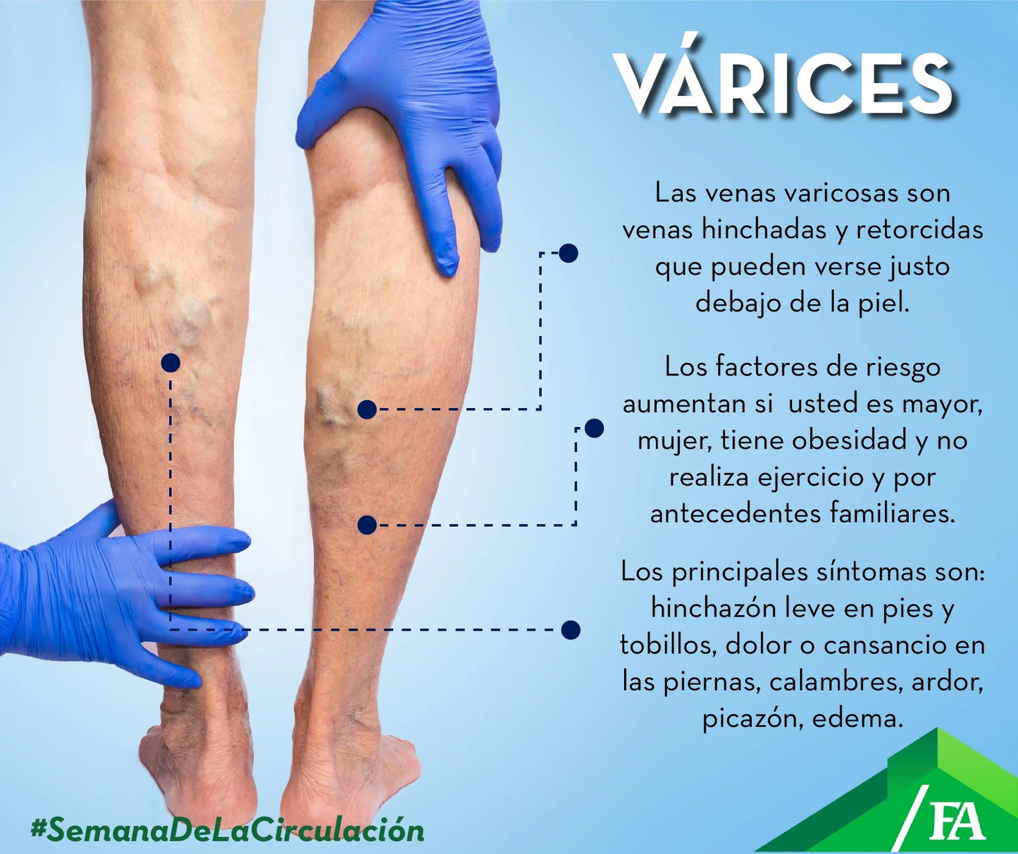Por fin podras eliminar las horribles varices